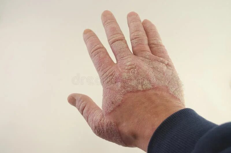 Псориаз фото на руках симптомы и лечение Exacerbation of Psoriasis in the Hands Stock Image - Image of background, isolat