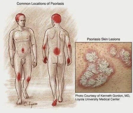 Псориаз фото на теле симптомы Health Center: PsoriasisPsoriasis is one of the most stubborn skin diseases. It 