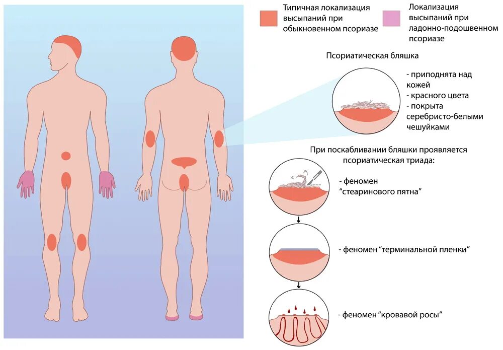 Псориаз фото на теле симптомы Симптомы мужского климакса: физиологические и психические аспекты