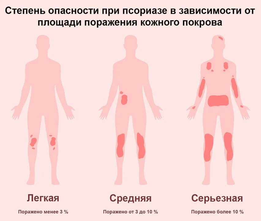 Псориаз фото на теле симптомы и лечение Псориаз