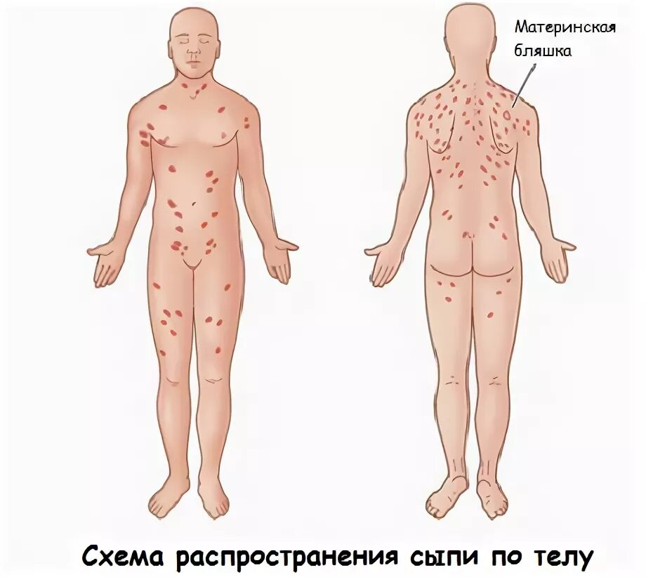 Псориаз фото на теле симптомы и лечение Pink deprive Zhibera: symptoms, diagnosis and treatment of the disease - Estet-P