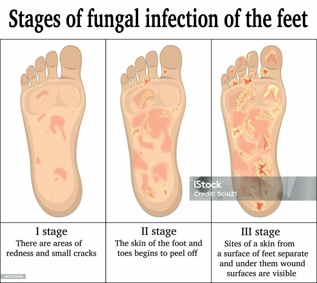 Псориаз фото начальной стадии на ногах Грибковая Инфекция На Ногах - стоковая векторная графика и другие изображения на