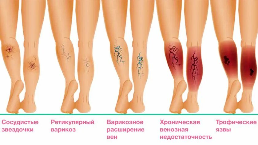 Псориаз фото начальной стадии на ногах Как лечить трофическую язву - Симптомы трофической язвы