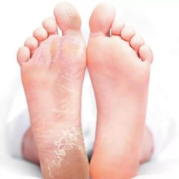 Псориаз фото начальной стадии на ногах Foot Peel Mask Exfoliation (com imagens) Cuidados com os pés, Camisas formandos