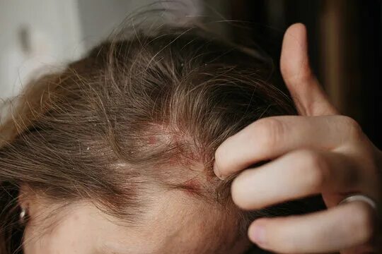 Псориаз головы симптомы и лечение фото Scalp Psoriasis Зображення - огляд 1,989 Стокові фото, векторні зображення й від