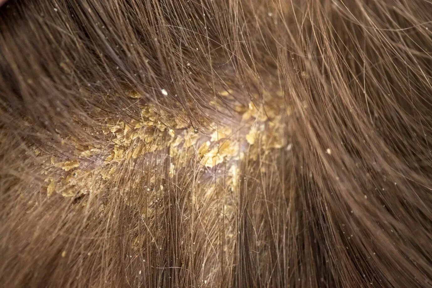 Псориаз и дерматит отличия на фото What is Yellow Dandruff and Why is it so? Head & Shoulders IN