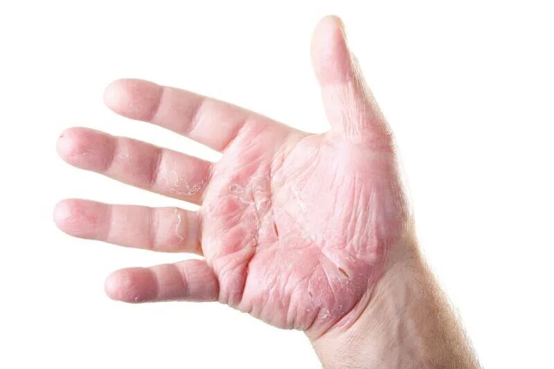 Псориаз на ладонях фото начальная стадия Hand and finger eczema (chronic hand eczema) Ducray