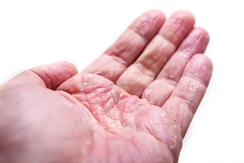 Псориаз на руках фото Closeup of Eczema Dermatitis on Back Fingers Stock Image - Image of condition, h