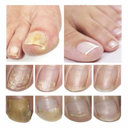 Псориаз ногтей на ногах фото Anti Fungal Nail Treatment Finger Toe Care Fungus Fungi Liquid Repair Liquid Pen