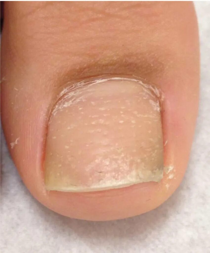 Псориаз ногтей на ногах фото Significant nail pitting and onycholysis are depicted on this image. Download Sc