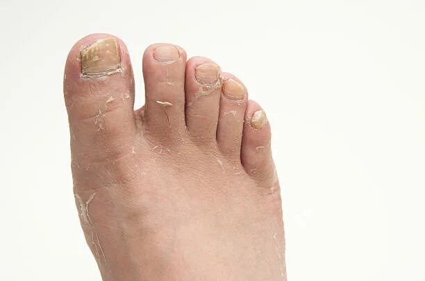 Псориаз ногтей на ногах фото лечение Более 1 700 работ на тему "Pictures Of Athletes Foot Pictures": стоковые фото, к