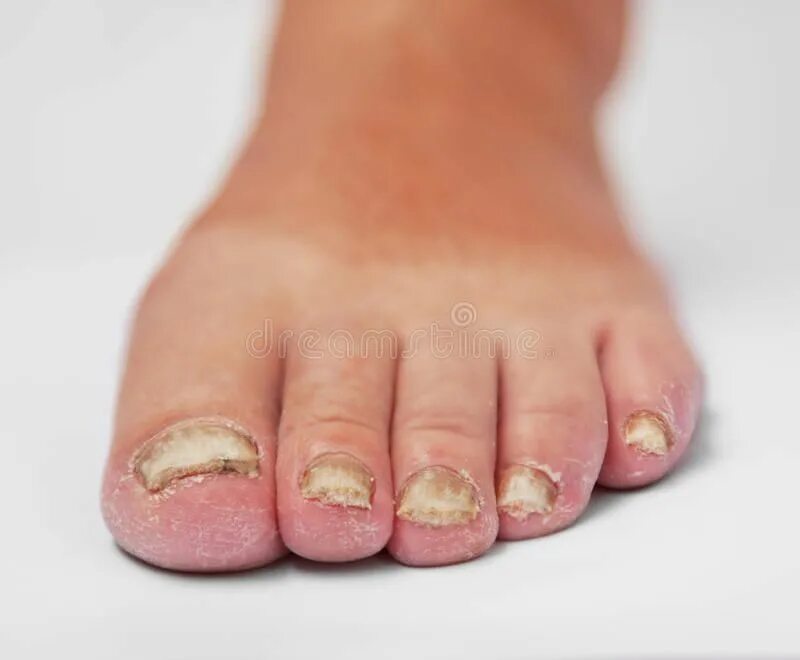 Псориаз ногтей на ногах фото лечение Fungal Disease. Fungoid disease of a nail , #Sponsored, #Disease, #Fungal, #Fung