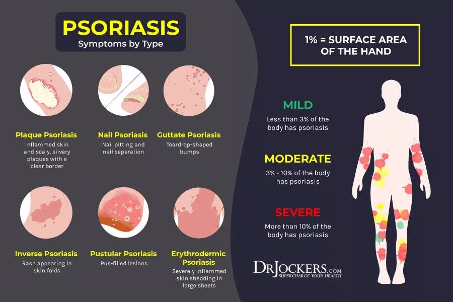 Псориаз симптомы фото причины Psoriasis: Causes, Symptoms & Natural Support Strategies