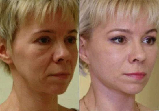 Птоз лица фото Hiçbir botoks işlemi olmadan 15 yaş önceki görünüm garantisi Botox, Falten gesic