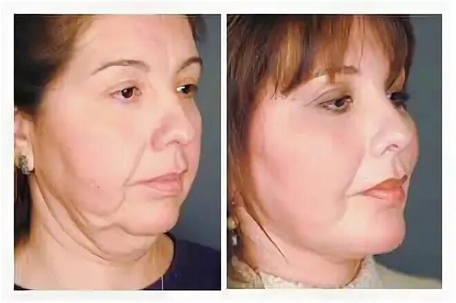 Птоз лица фото до и после Facelifting - Plastische Chirurgie Vorher und Nachher - #Gesicht #Lift #Kunststo