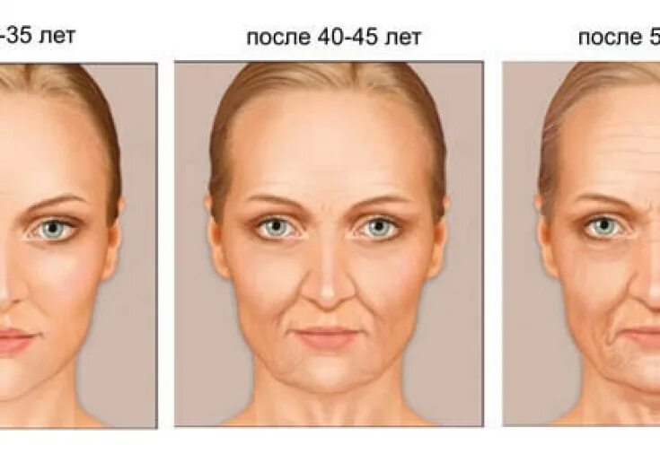 Птоз лица фото после 40 лет Correction with fillers of the orbital zone is effective not only for skin aging