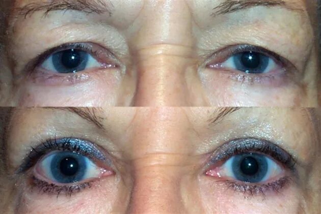 Птоз нижнего века фото Cosmetic and Reconstructive Surgery of eyelids, orbits, and tear ducts