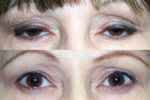 Птоз век макияж Cosmetic and Reconstructive Surgery of eyelids, orbits, and tear ducts