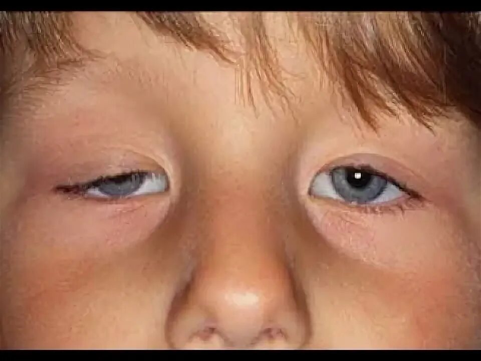 Птоз века у ребенка фото Cas clinique corrigé en Ophtalmologie : Ptosis chez l'enfant - YouTube