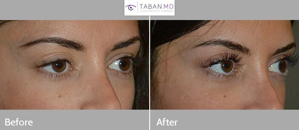 Птоз верхнего века фото Eyelid Ptosis ( Droopy Eyelid ) Surgery Dr. Mehryar (Ray) Taban MD Oculoplastic 