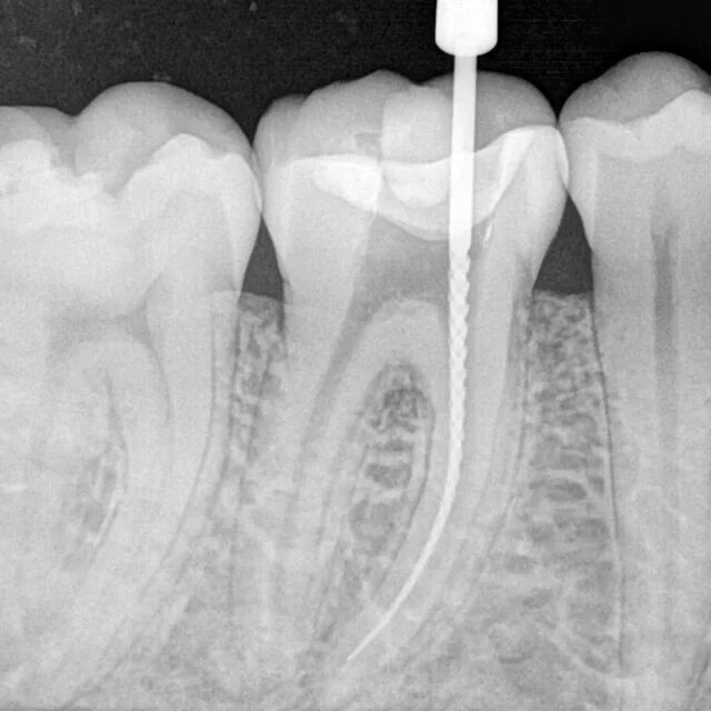 Пульпит как выглядит фото на зубе живое Радиовизиография зуба - СТОМАТОЛОГИЧЕСКАЯ КЛИНИКА "СтомаДент"