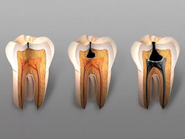 Пульпит как выглядит фото на зубе живое Кариес зубов, лечение в Москве