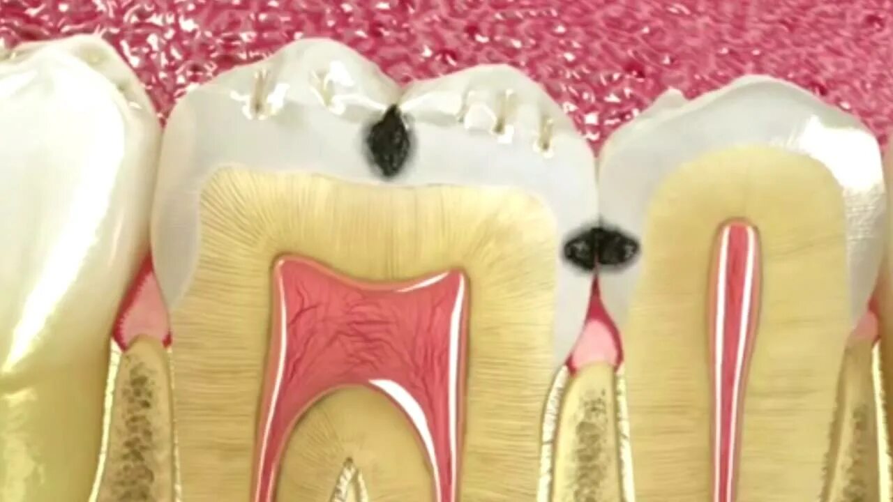 Пульпит как выглядит фото на зубе живое ENDODONCIA SANA RISA - YouTube