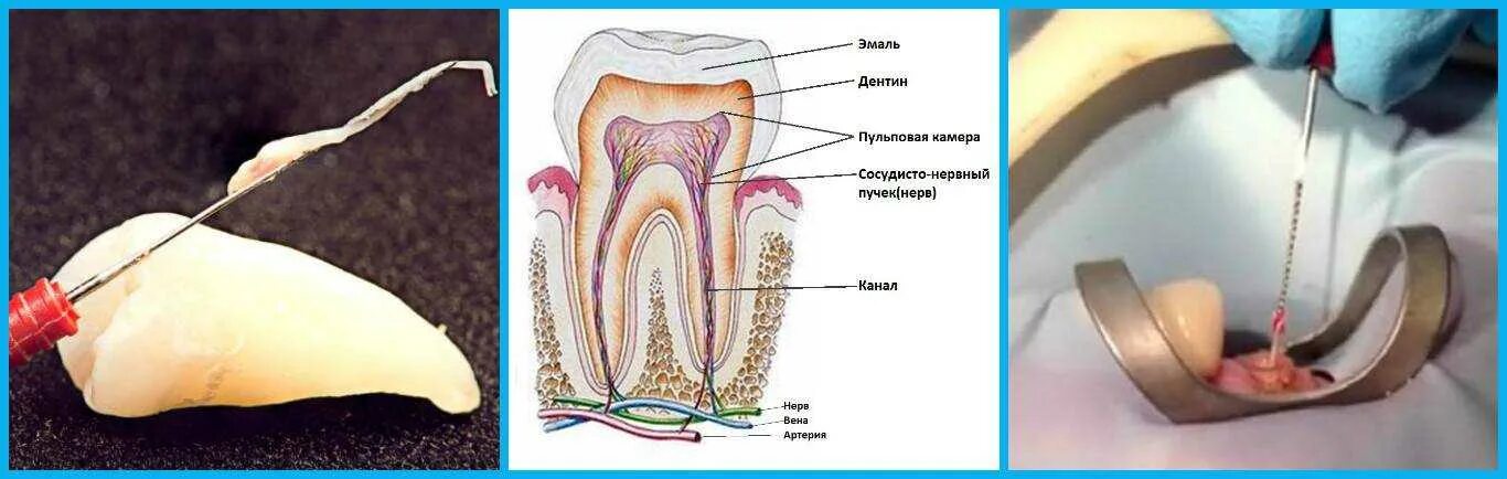 Пульпит как выглядит фото на зубе живое Удаление нерва болит