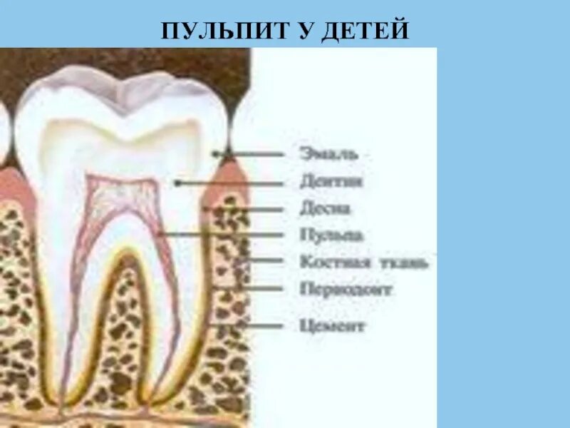 Пульпит у детей молочных зубов фото Особенности клинического течения , даигностики и лечения пульпитов у детей