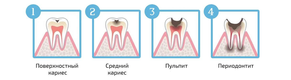 Пульпит у детей молочных зубов фото Лечение пульпита молочных зубов у детей в Москве - Стоимость услуги по акции на 