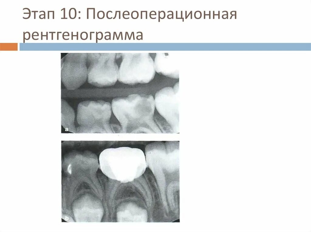 Пульпит у детей молочных зубов фото Пульпит временных и постоянных зубов у детей - презентация онлайн