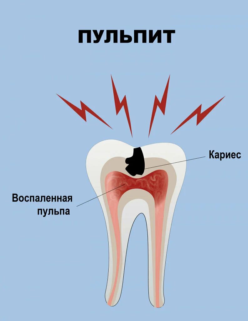 Пульпит зуба как выглядит снаружи Happy Clinic, dental clinic, Краснодар, проспект Константина Образцова, 6/1 - Ya