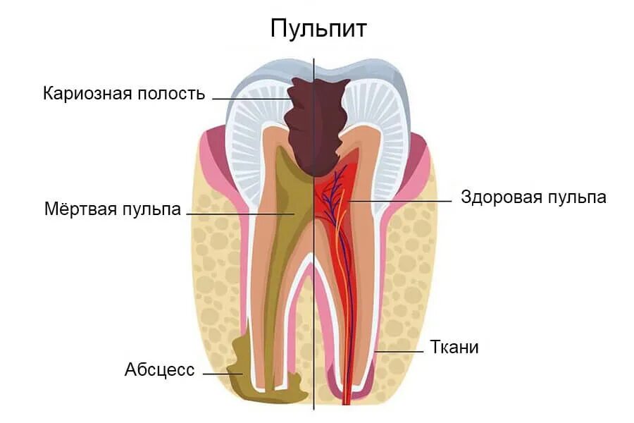 Пульпит зуба как выглядит снаружи Лечение пульпита одноканального зуба недорого в Реутове и Новокосино - стоматоло