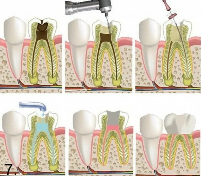 Пульпит зуба как выглядит снаружи Лечения пульпита зуба по доступным ценам в Новосибирске