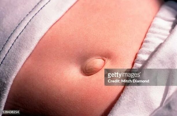 Пупочная грыжа начальная стадия фото Belly Button High-Res Stock Photo - Getty Images