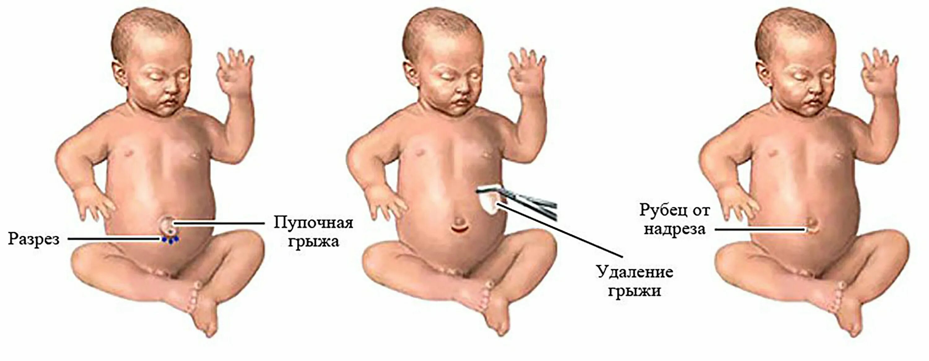 Пупочная грыжа начальная стадия фото Пупочная грыжа что можно кушать: найдено 86 картинок