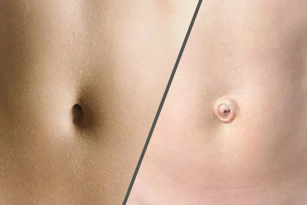 Пупочная грыжа симптомы у женщин фото Innies Vs. Outies - What Decides The Shape Of Your Belly Button?