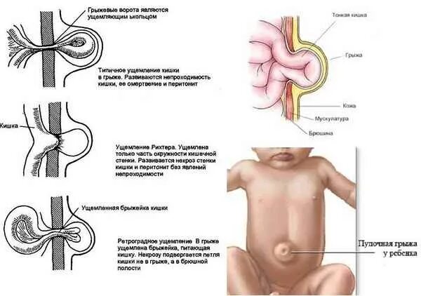 Пупочная грыжа стадии фото Способы лечения пупочной грыжи у ребёнка, признаки Русский спорт - научная база