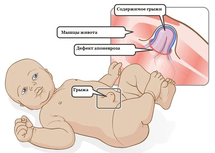 Пупочная грыжа у новорожденного фото как выглядит Пупочная грыжа у детей: ждать или оперировать? - Благотворительный фонд помощи н