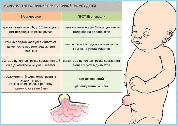 Пупочная грыжа у новорожденного фото как выглядит Грыжи у детей - пупочная и паховая, но могут быть и другие варианты. О детском з