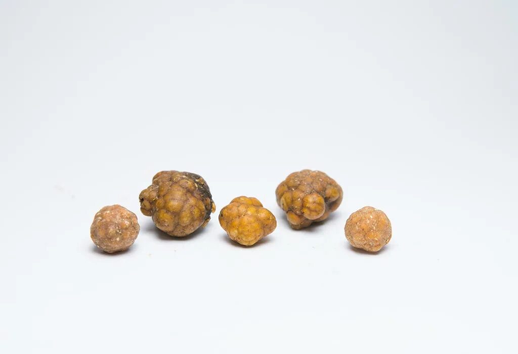 Пупочные камни как выглядят Gallstones in Pregnancy: Types, Causes, Symptoms & Treatment