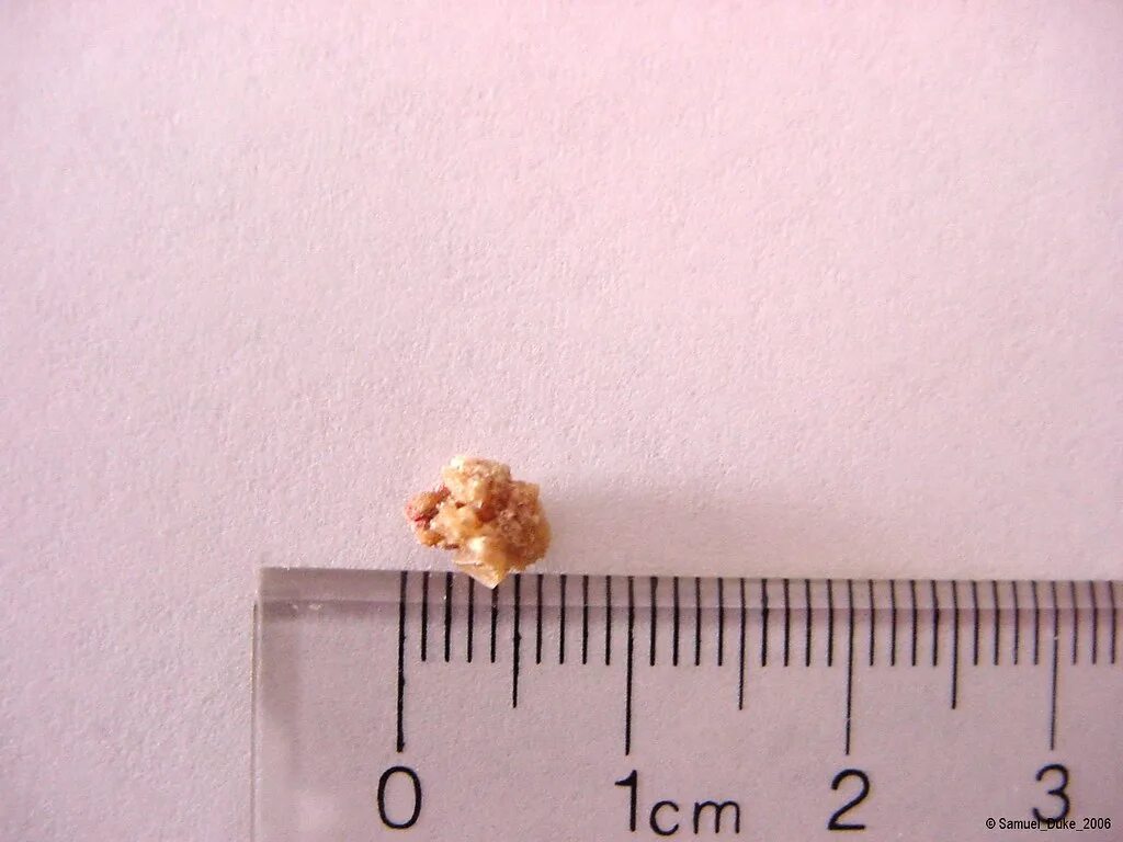 Пупочные камни как выглядят 6.5mm X 5mm Kidney Stone Sam Flickr