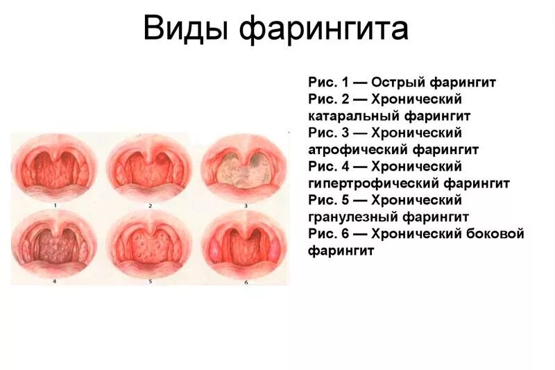 Пупырышки на задней стенке горла фото Что такое фарингит. Вирусный и бактериальный фарингит