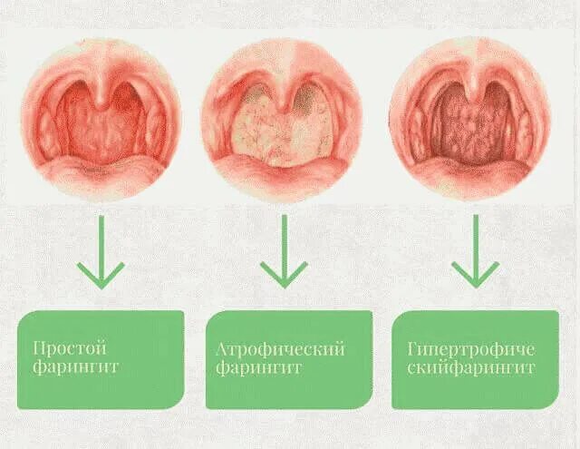 Пупырышки на задней стенке горла фото Фарингит острый и хронический у взрослых - о чем нужно знать Наш дом в Новоросси