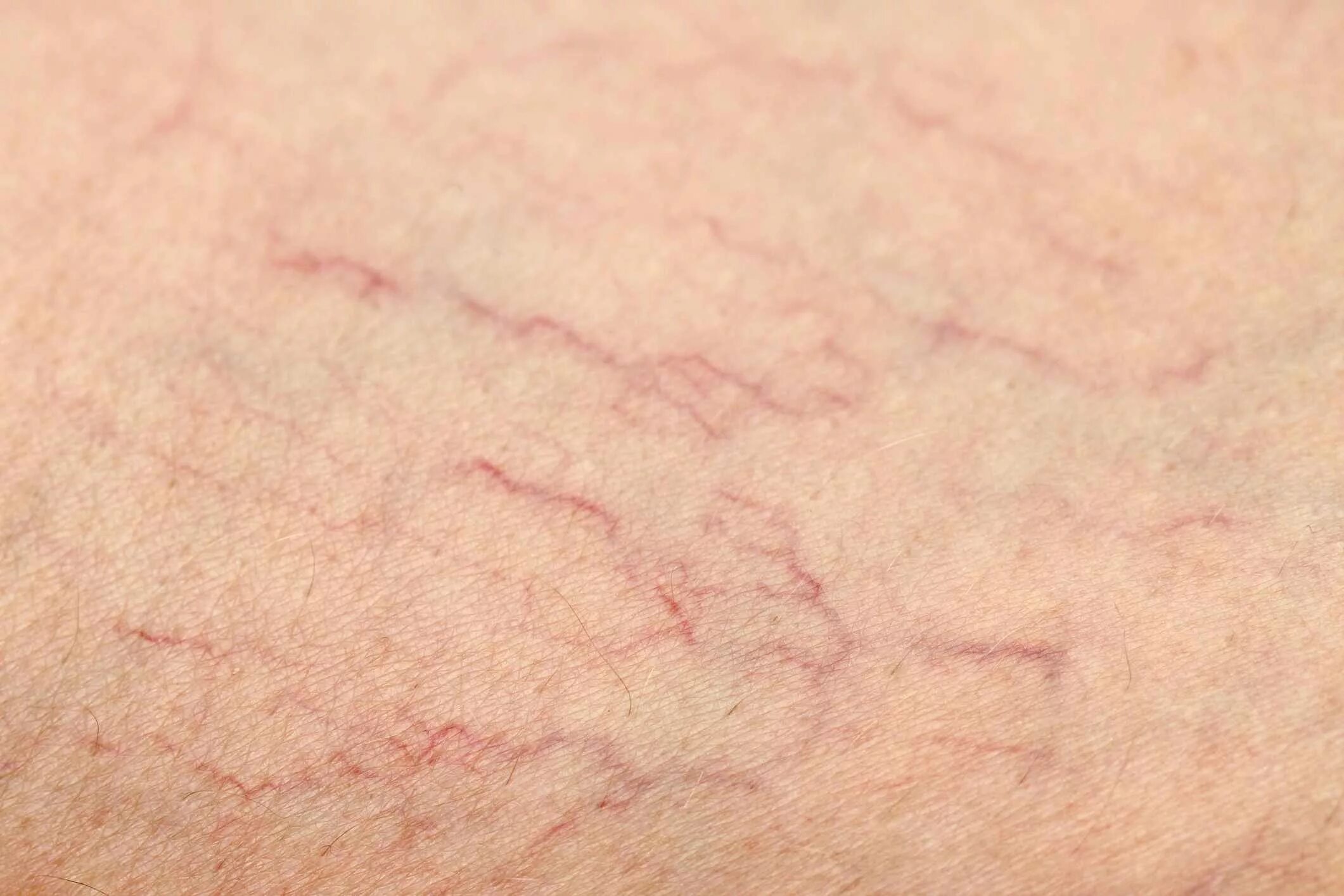 Пурпура симптомы фото Causes and Prevention of Varicose and Spider Veins