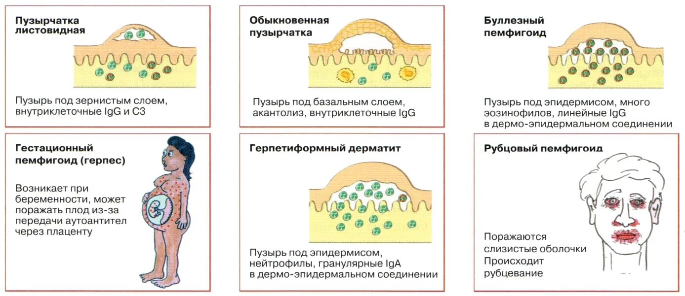 Пузырчатка болезнь фото у взрослых симптомы Farmf литература для фармацевтов : Лекции " Пузырчатка (пемфигус). Классификация