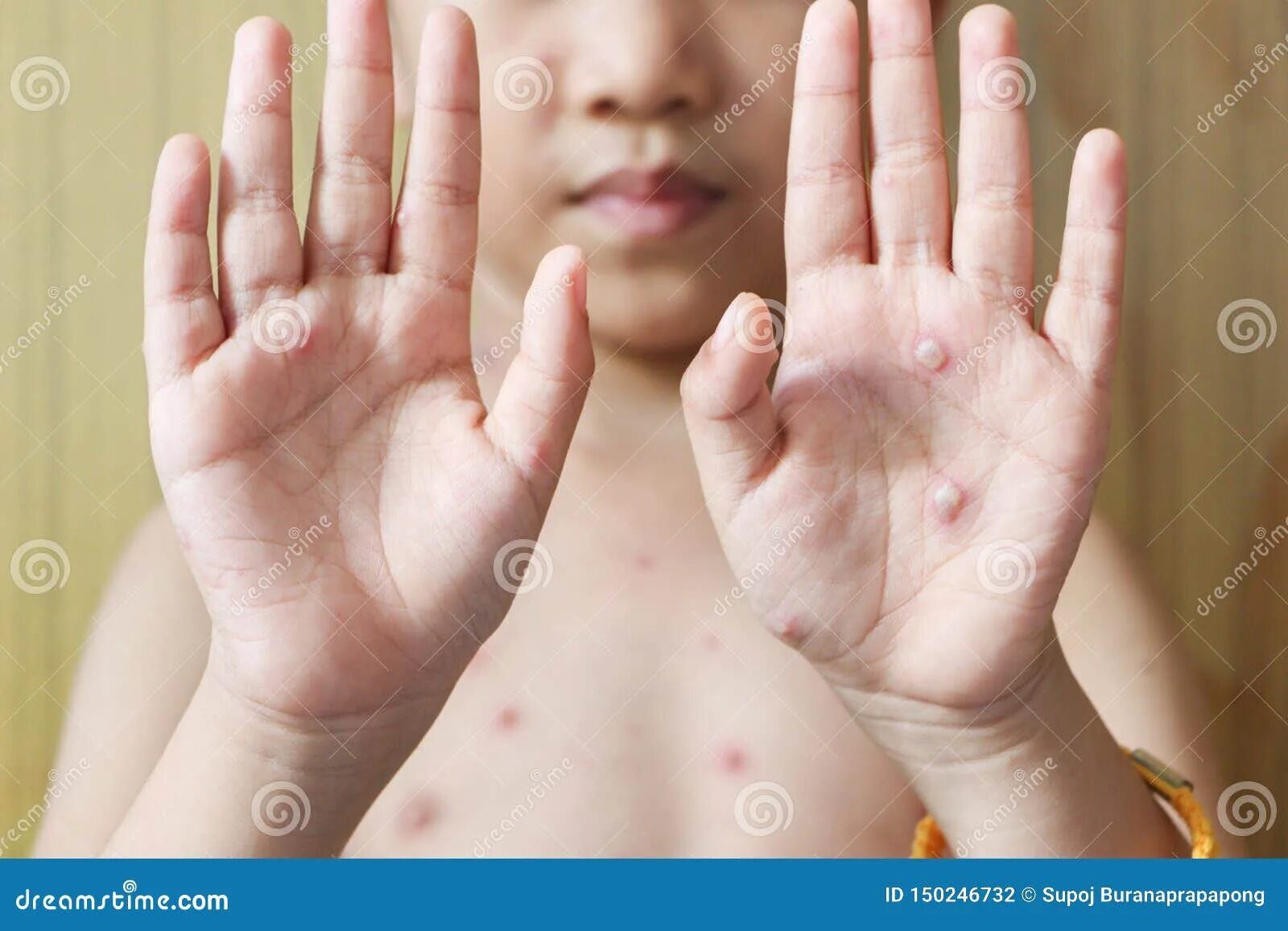 Пузырчатка болезнь фото у взрослых симптомы Chicken Pox Rash on Young Boy Body.Chickenpox is an Infection Caused by the Vari