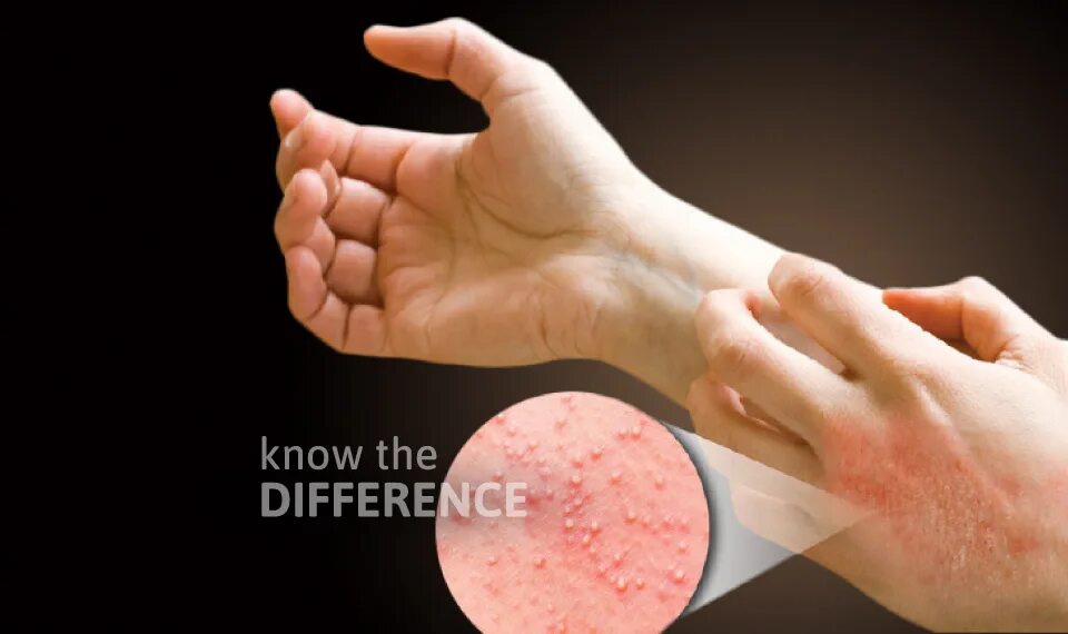 Пузырчатый дерматит фото Taiwan Know The Difference - not all skin reaction is an allergy