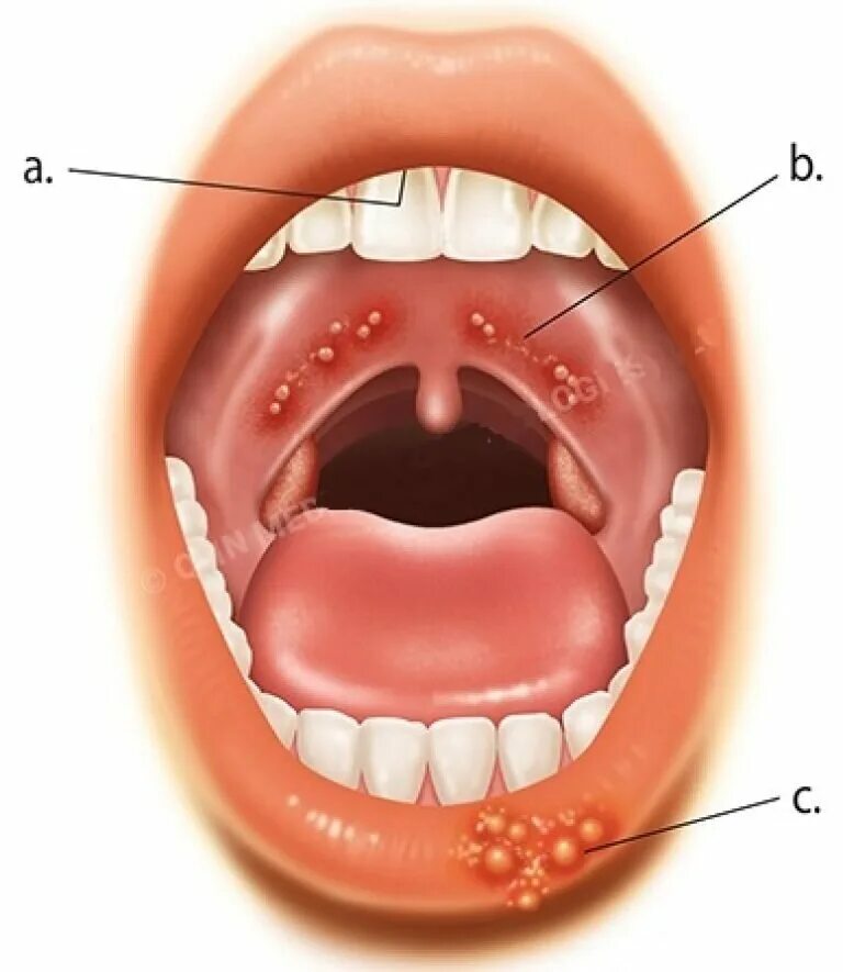 Пузыри на горле фото Герпес: причины, симптомы, и лечение вируса пошагово