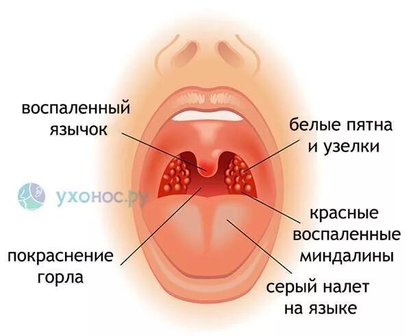 Пузыри на горле у ребенка фото У грудничка ангина форум: у ребенка ангина - 58 ответов на форуме Woman.ru - Тал